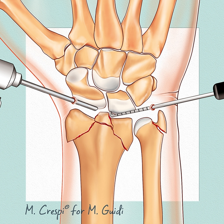Fratture di Polso