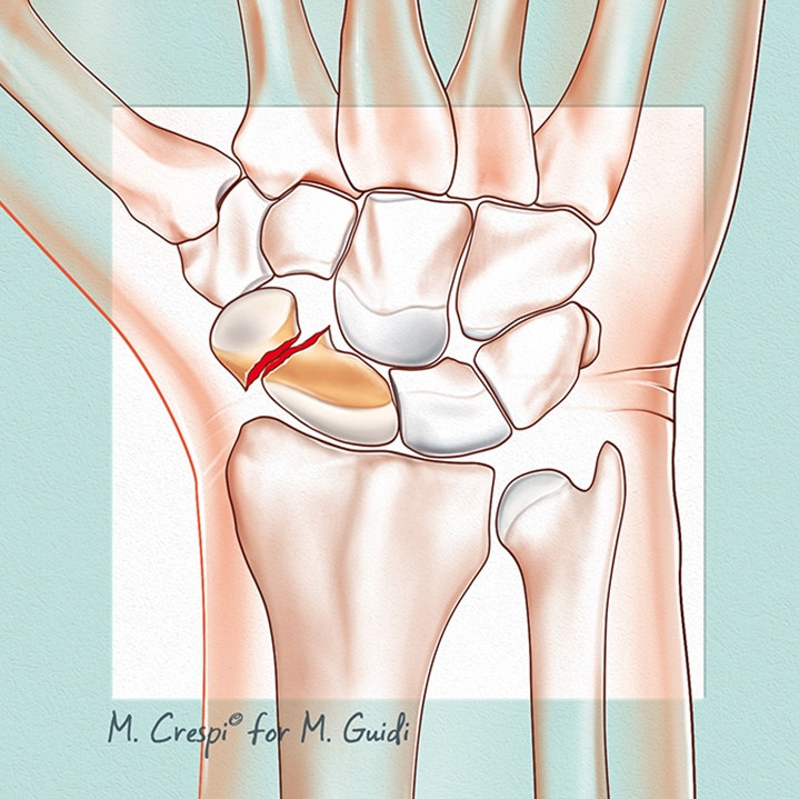 Frattura dello Scafoide